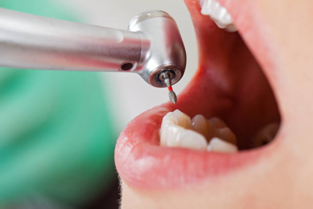 Best Broken or Chipped Tooth Repair in Georgetown, SC